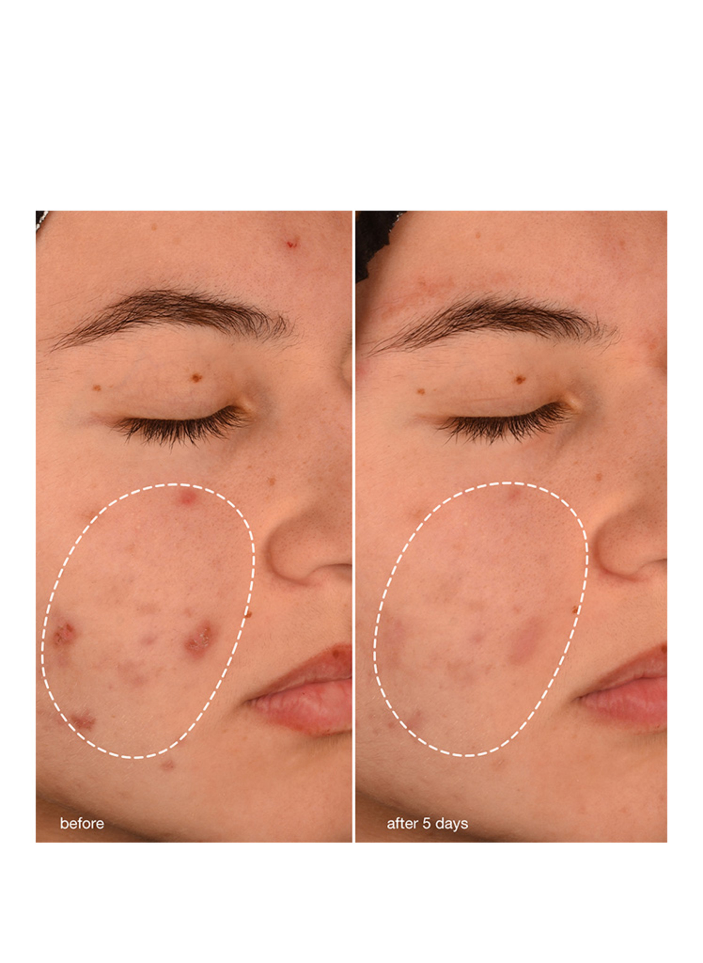 Thumbnail - Dermalogica Breakout Biotic Moisturizer Gel-Feuchtigkeitscreme 50 ml