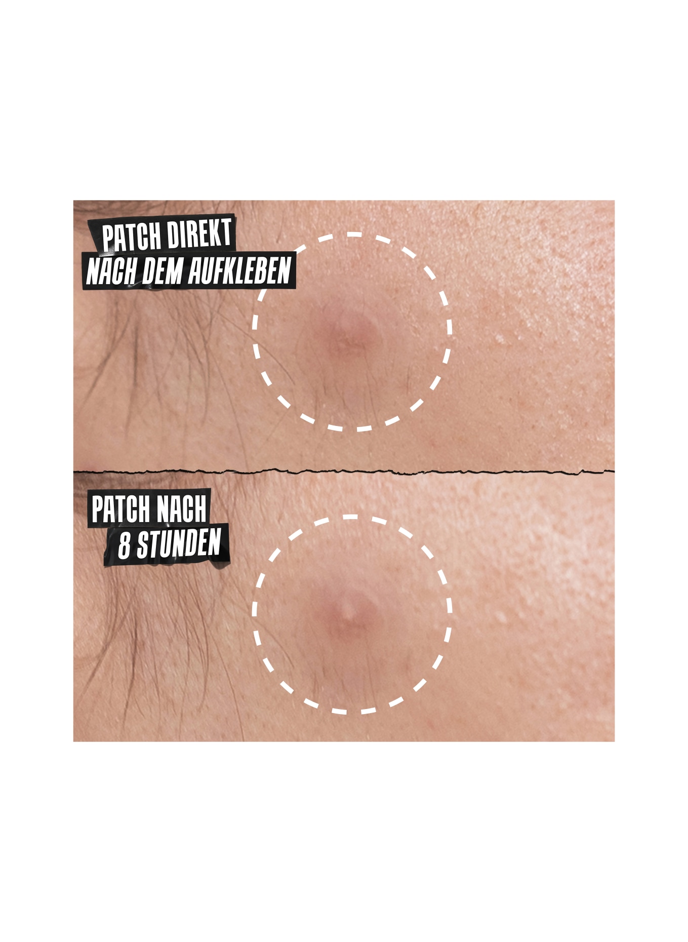 Kiehl's TRULY TARGETED OVERNIGHT ACNE PATCH